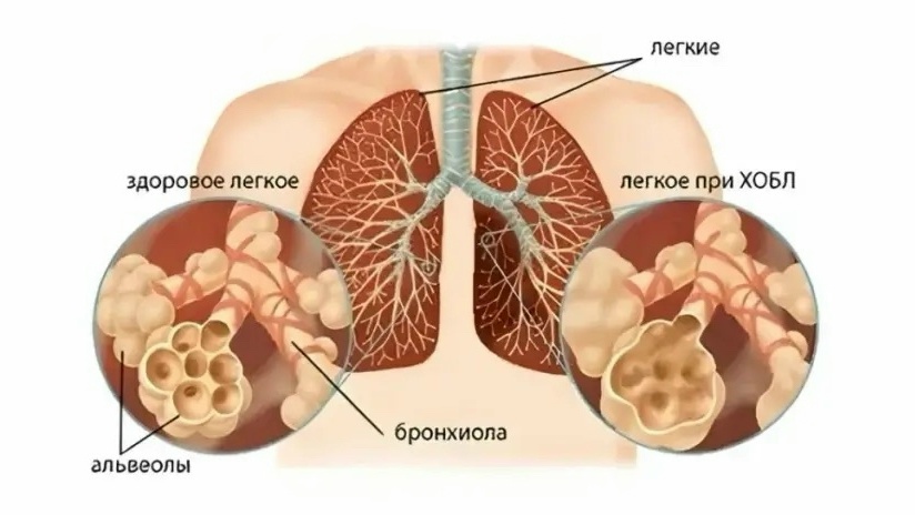 ХОБЛ и курение: как избежать опасной болезни